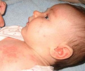 apa penyebab timbulnya bintik merah pada kulit bayi