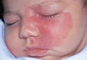 tanda lahir warna merah pada bayi, berbahayakah?